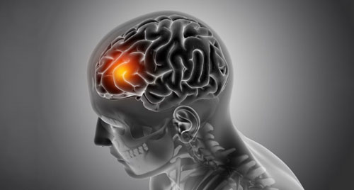 Acute Stroke Care